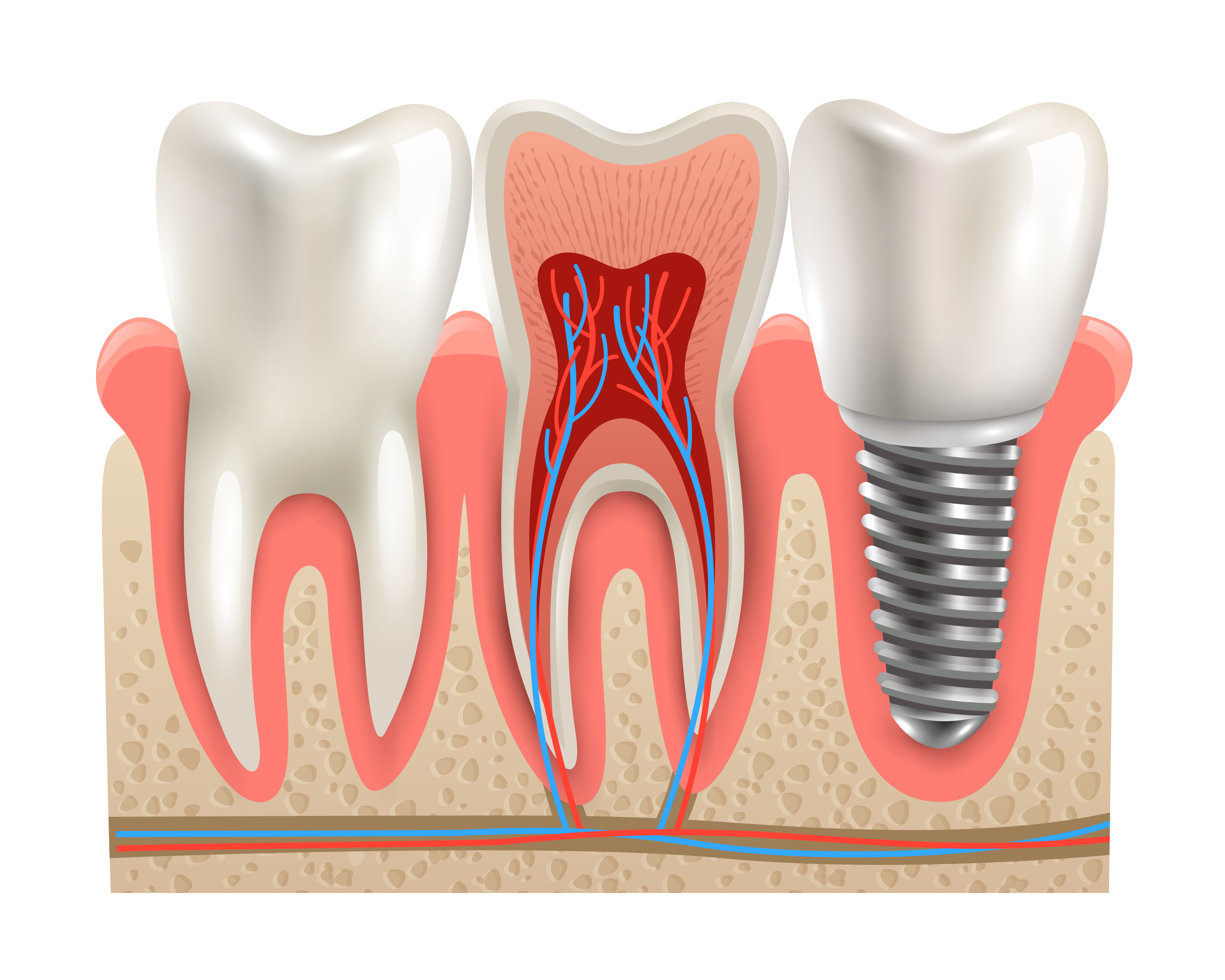 Dental İmplant Uygulaması Nedir? Nasıl Yapılır? En Çok Sorulan Sorular?